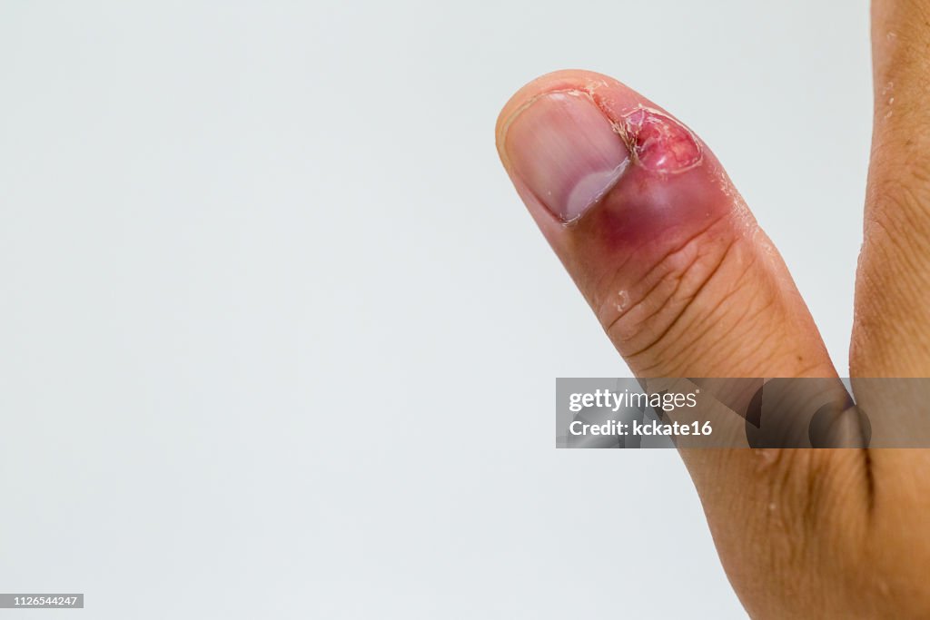 Poison Finger Paronychia Swollen Finger With Fingernail Bed Inflammation Due To ...