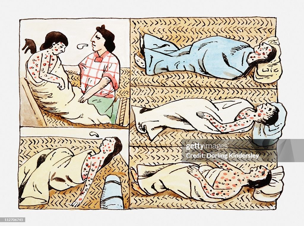 Illustrations of Aztec's suffering from smallpox virus spread by Spanish