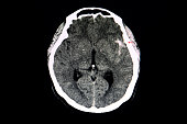 CT brain of a patient with aucte hemorrhagic stroke.