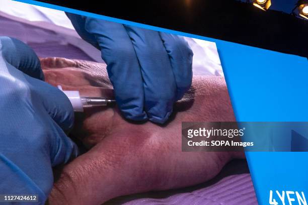 The hand of the volunteer Edgar Pons is seen during the Live Human Chip Implant Show. Edgar Pons has been implanted with an RFID chip in his hand....