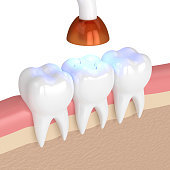 3d render of teeth with dental polymerization lamp and light cured inlay