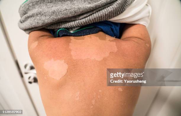 sunburned boy. sunburned heavily, white skin versus very dark red and burned - 日焼け ストックフォトと画像