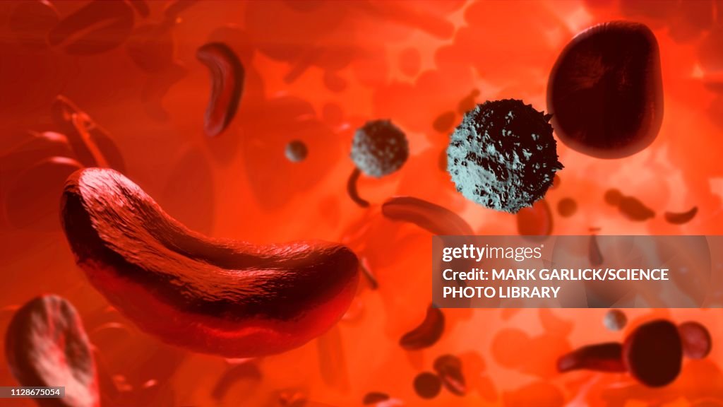 Sickle cell anaemia, illustration