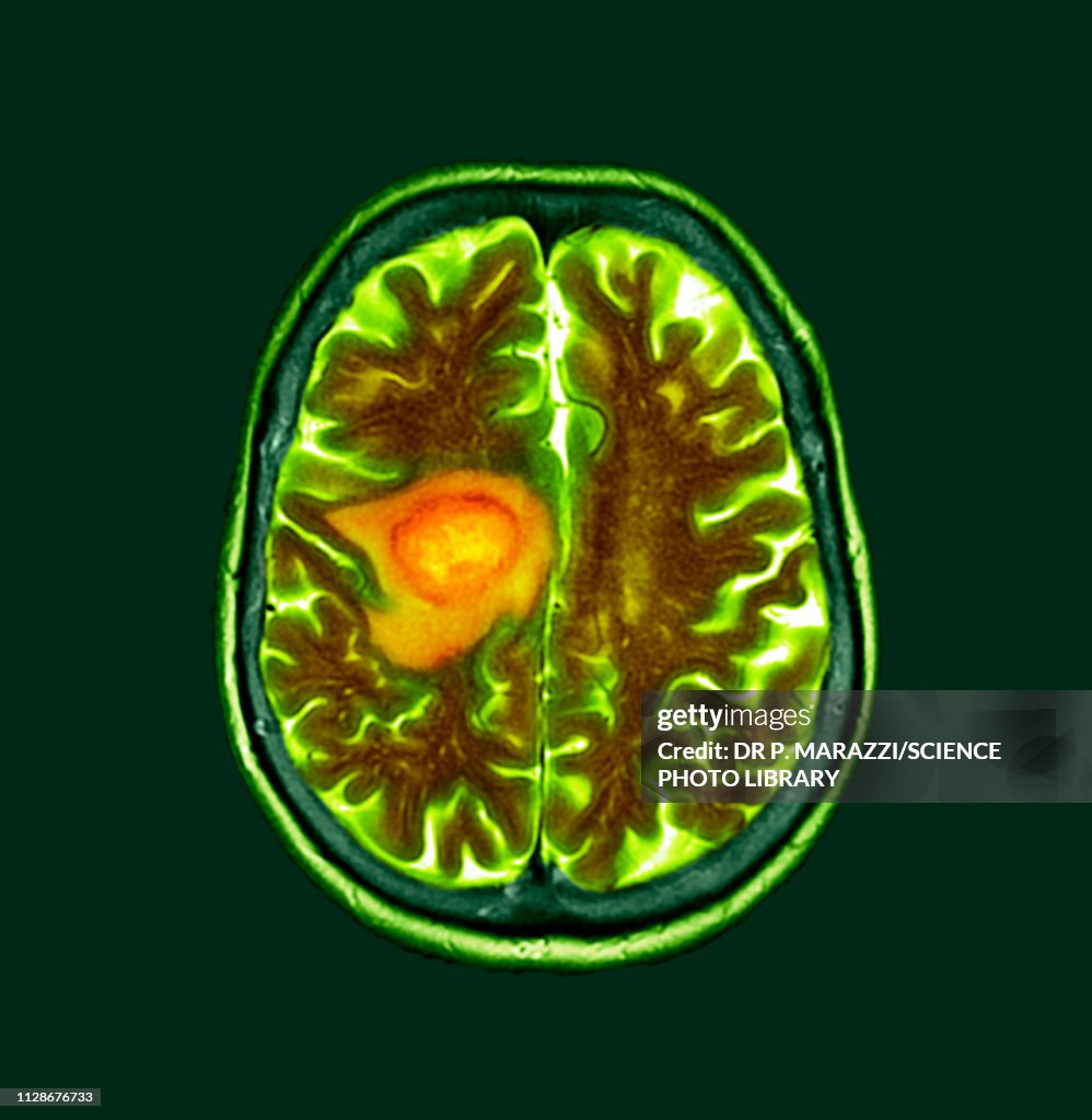 Glioblastoma brain cancer, CT scan