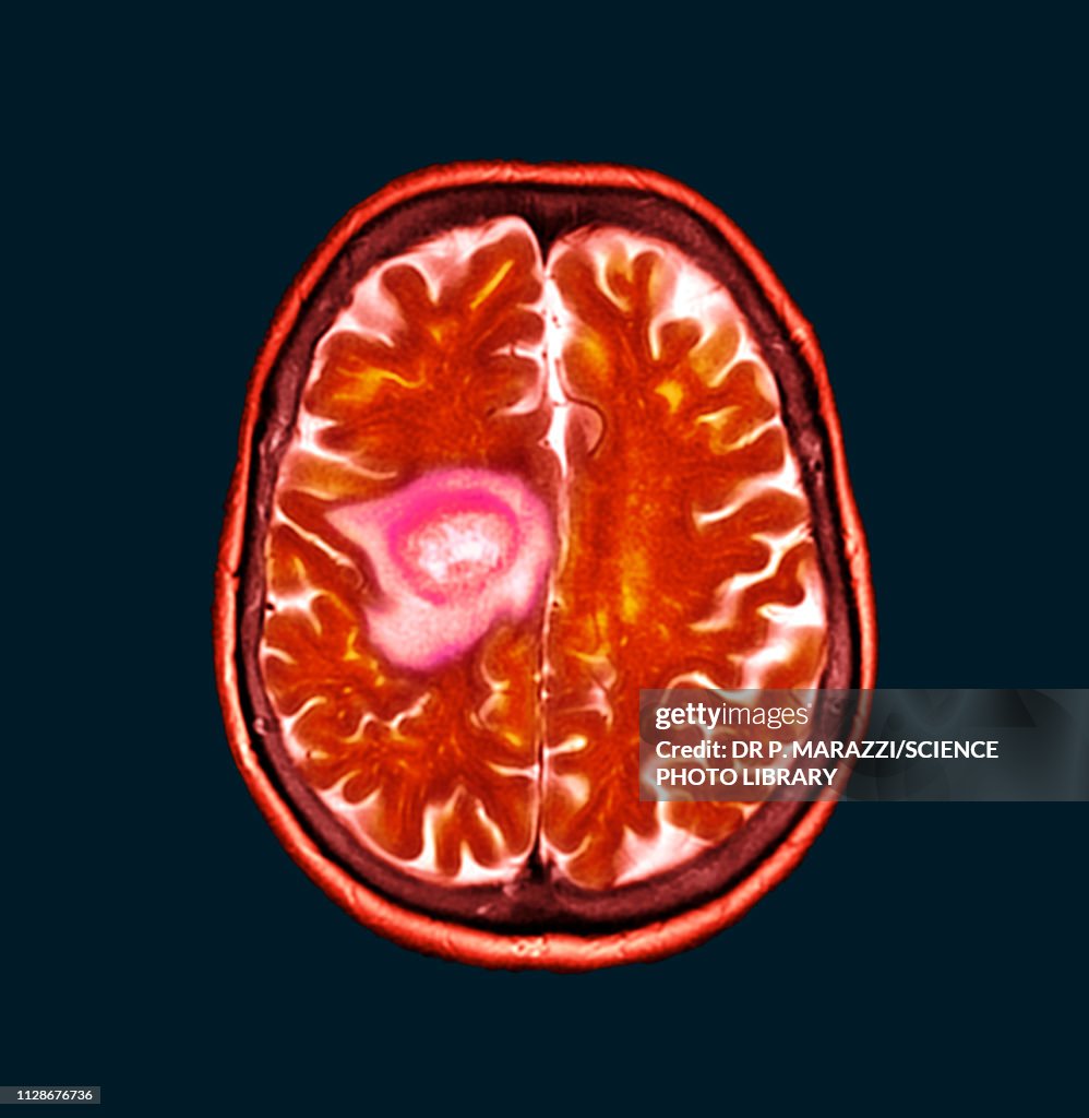 Glioblastoma brain cancer, CT scan