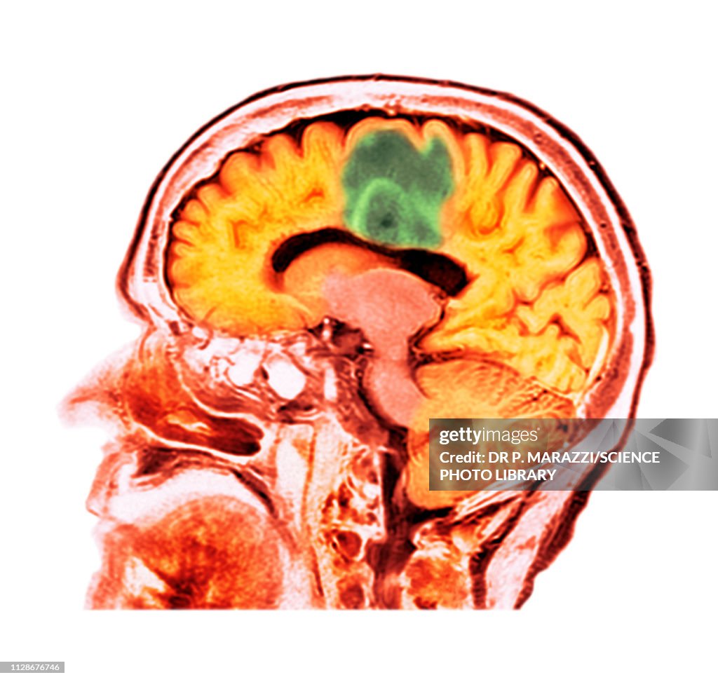 Glioblastoma brain cancer, CT scan