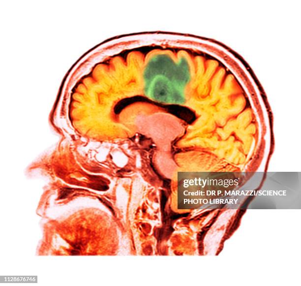 glioblastoma brain cancer, ct scan - brain cancer stock pictures, royalty-free photos & images