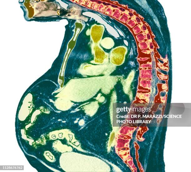 spine in ankylosing spondylitis, x-ray - ankylosing spondylitis stock pictures, royalty-free photos & images