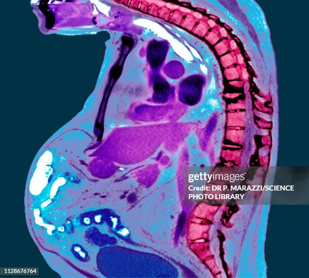 spine in ankylosing spondylitis, x-ray - ankylosing spondylitis stock pictures, royalty-free photos & images