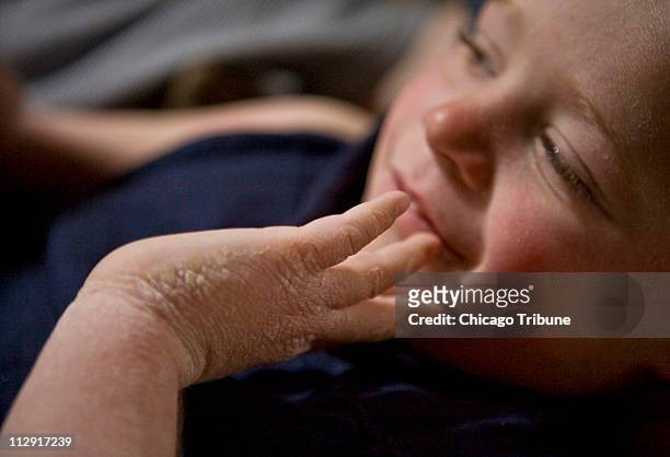 Ben Osowski is pictured at his home in Mokena, Illinois, on June 12, 2008. Ben suffers from epidermolytic hyperkeratosis, or EHK, a spontaneous form...