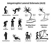 Amyotrophic lateral sclerosis ALS disease signs and symptoms.