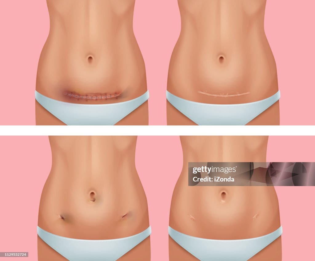 Vector set of fresh and healed scars on body after abdomen, wound from appendicitis removal surgery on background