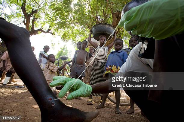 Medical worker Abaare Hussein, right, extracts a Guinea worm from a child's leg in Savelugu Village in northern Ghana, February 6, 2007. Hussein...