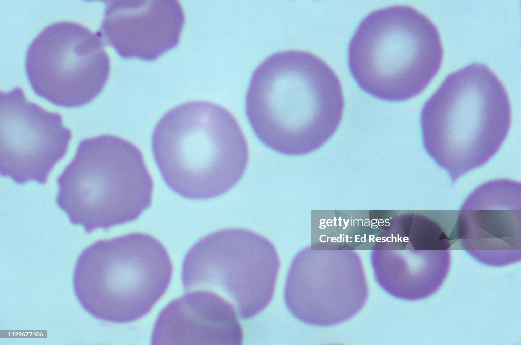 HYPOCHROMIC ANEMIA showing many pale red blood cells with decreased concentration of Hemoglobin