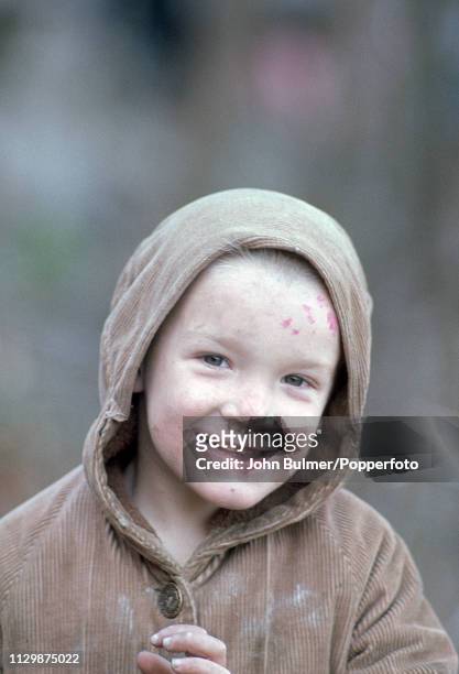 Portrait of a young boy with a skin rash, Pike County, Kentucky, US, 1967.