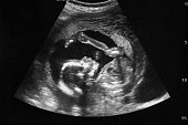 Ultrasound with pregnancy Obstetric of fetus Medical images. pregnant mother.