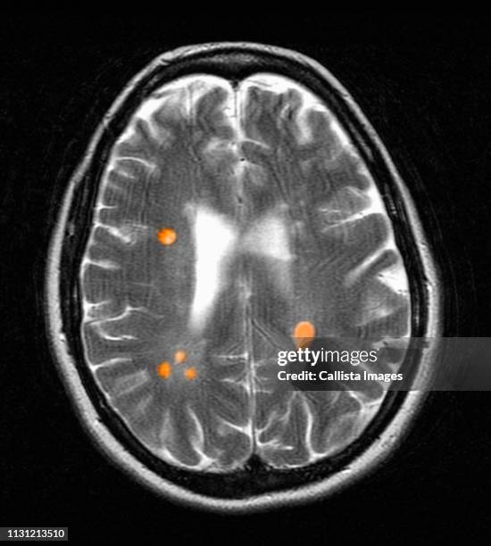 mri of multiple sclerosis in a 42 year old woman - tronco cerebral imagens e fotografias de stock