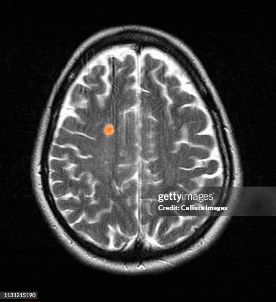 mri of multiple sclerosis in a 42 year old woman - medical scanner fotografías e imágenes de stock