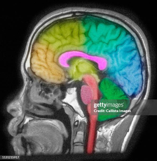 mri of head showing brain structures - skull xray no brain stock pictures, royalty-free photos & images