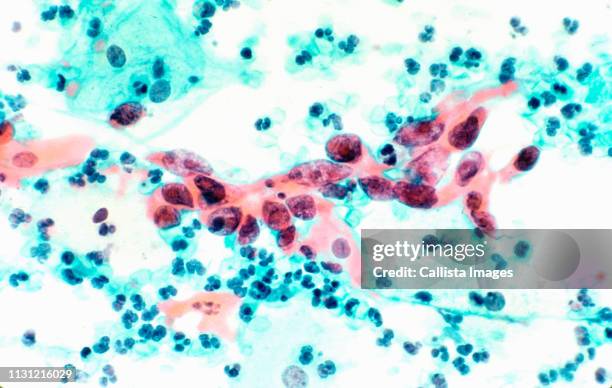 photomicrograph, squamous cell carcinoma of cervix - lichtmicroscopische-foto stockfoto's en -beelden