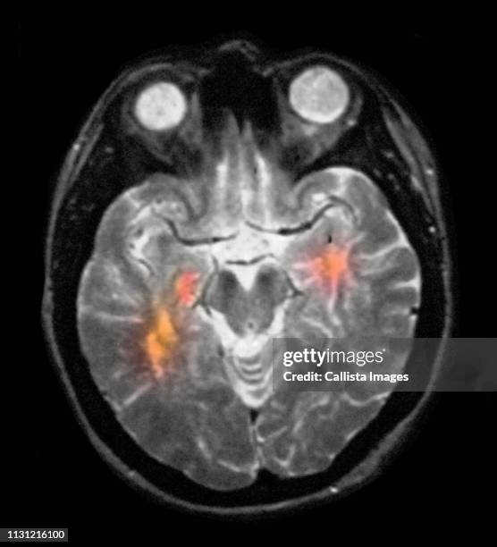 brain mri showing multiple sclerosis - skull xray no brain stock pictures, royalty-free photos & images