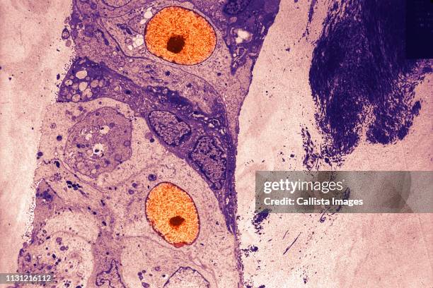 electron micrograph of a breast cancer cell - micrografía científica fotografías e imágenes de stock