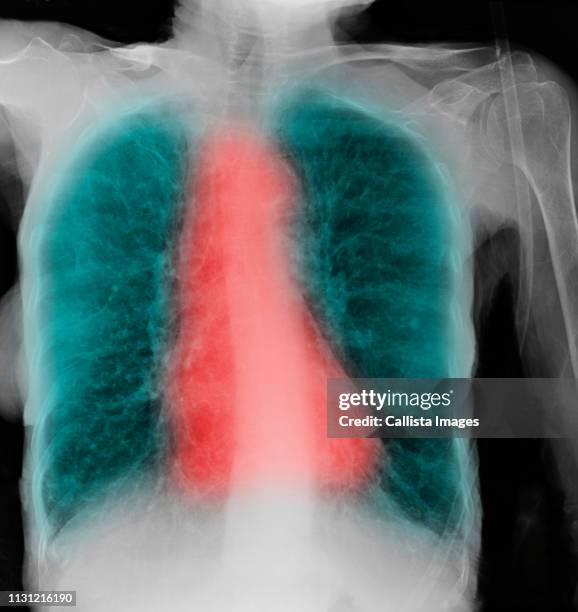 cxr of elderly woman smoker with copd - calcification stock pictures, royalty-free photos & images