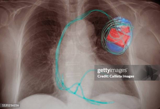 chest x-ray showing an implanted pacemaker - a v pacemaker stock pictures, royalty-free photos & images