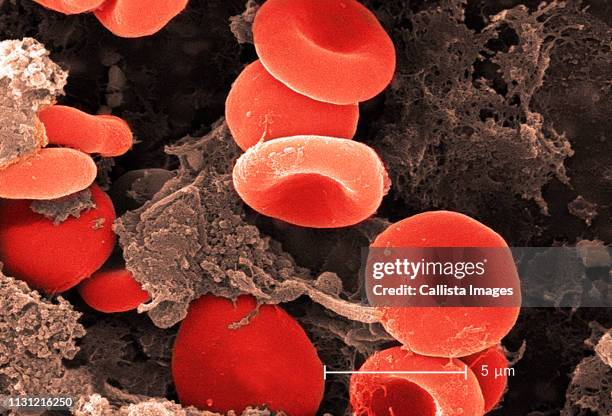 electron micrograph of red blood cells and fibrin - micrografia elettronica a scansione foto e immagini stock