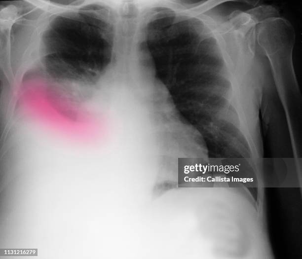 chest x-ray showing pleural effusion - cirrhosis bildbanksfoton och bilder