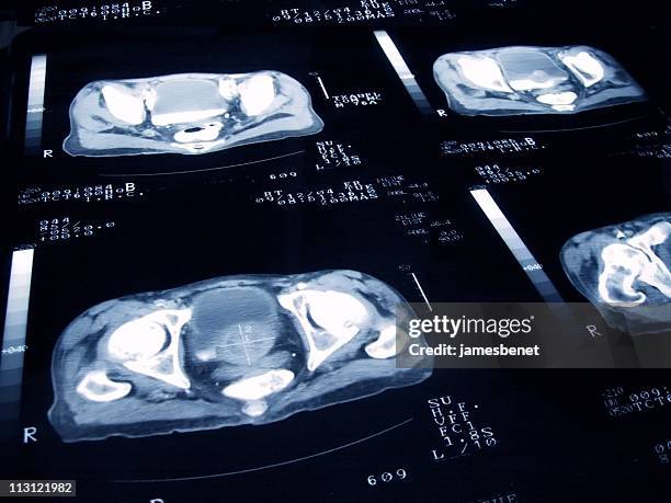 carcinoma alla prostata diapositiva - scanner medico foto e immagini stock