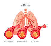 Asthma disease vector icon in flat style