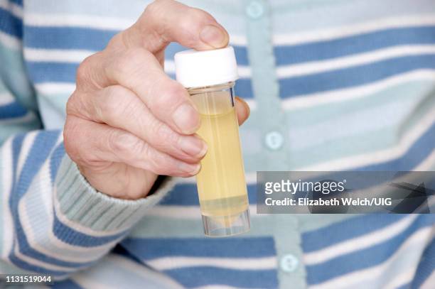 elderly woman with a sterile universal container with a urine specimen ready for analysis - a container for urine stock-fotos und bilder