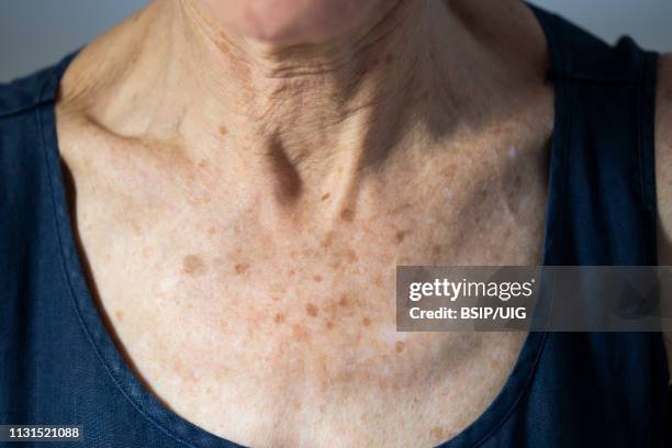 neck of old woman - keratosis photos et images de collection