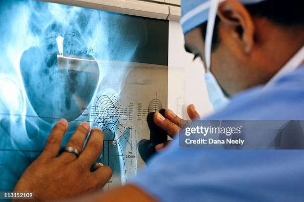 measuring for implant during orthopedic surgery - coluna vertebral humana imagens e fotografias de stock