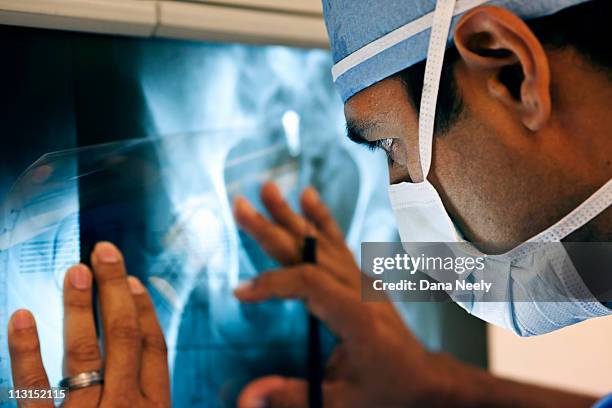 measuring for implant during orthopedic surgery - orthopedic surgery stock pictures, royalty-free photos & images