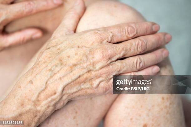 hand with spots of old age - keratosis photos et images de collection