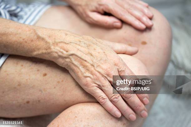 hands with spots of old age - lentigo stockfoto's en -beelden