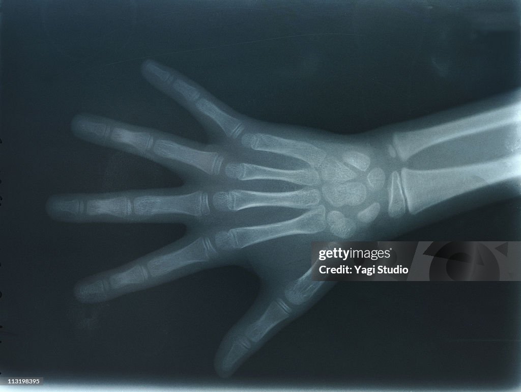 The hand of the child reflected by X-rays