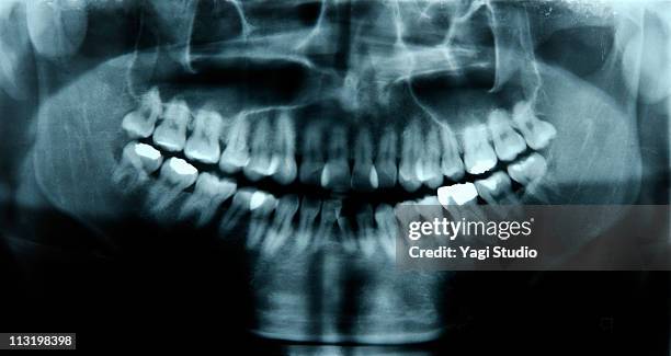 dental x-rays - dental filling stockfoto's en -beelden