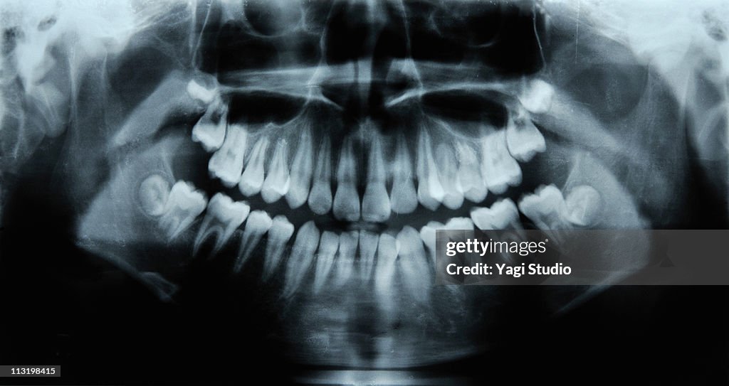 Child's dental X-rays