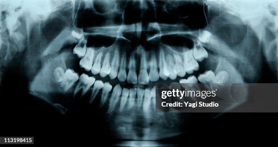 Child's dental X-rays Child's dental X-rays