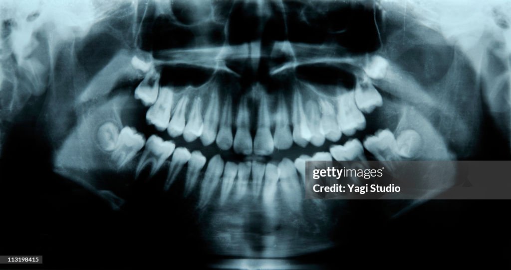 Child's dental X-rays