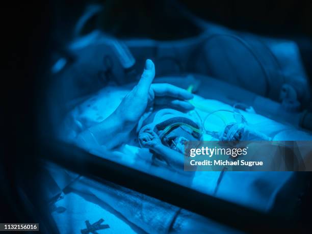 A nurse treats a baby in an isolet with hyperbillirubinemia in the neonatal intensive care unit of a hospital.