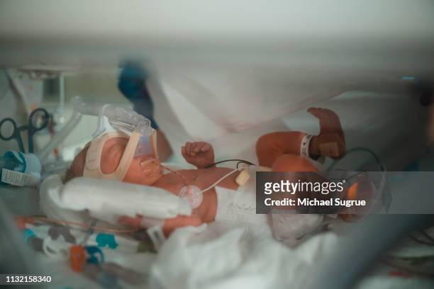A nurse treats a baby in an isolet with hyperbillirubinemia in the neonatal intensive care unit of a hospital.