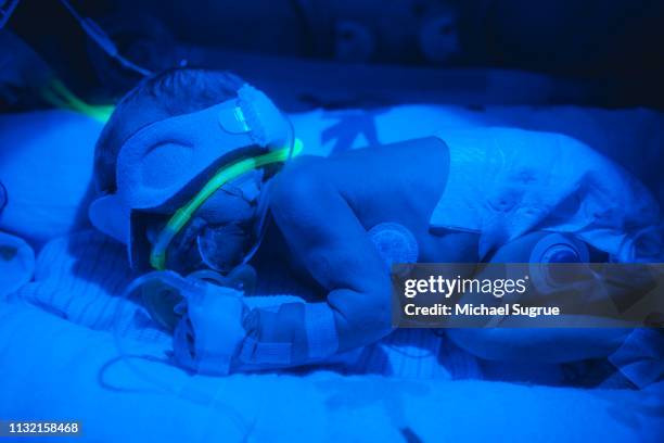 A nurse treats a baby in an isolet with hyperbillirubinemia in the neonatal intensive care unit of a hospital.