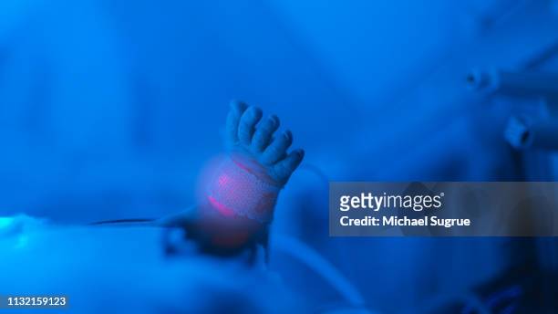 A newborn baby with hyperbillirubinemia lies in an isolet in the neonatal intensive care unit of a hospital.