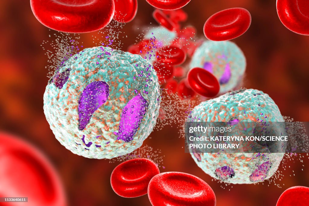 Acute lymphoblastic leukaemia treatment, illustration