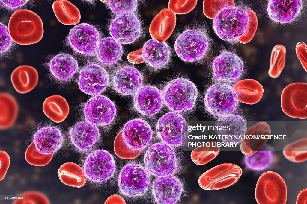 Acute lymphoblastic leukaemia treatment, illustration