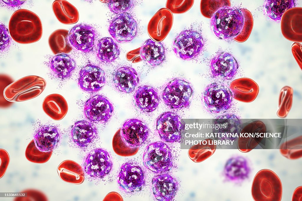 Acute lymphoblastic leukaemia treatment, illustration